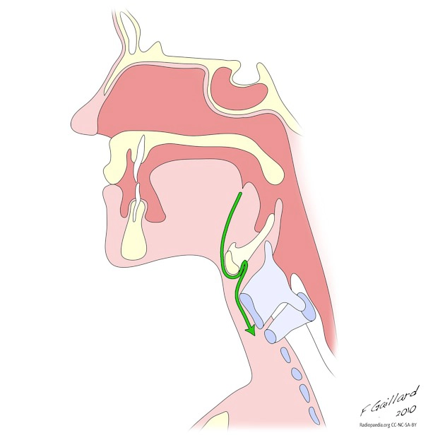 Nang ống giáp lưỡi (Thyroglossal duct cysts - TGDC)