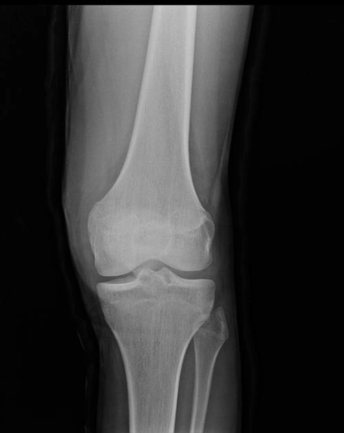 Gãy Hoffa (gãy lồi cầu xương đùi)