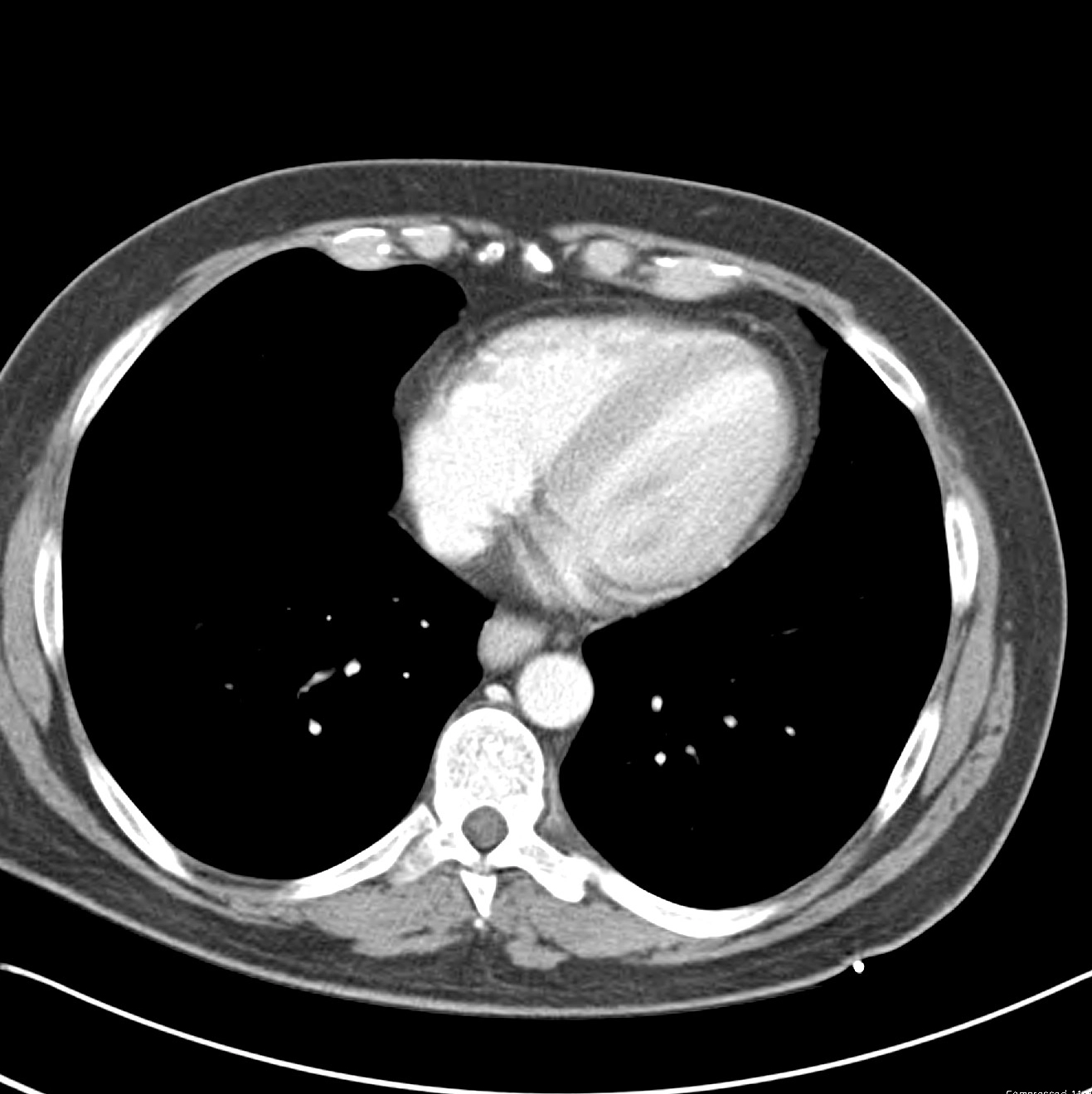 Thiếu máu mạc treo do tắc tĩnh mạch (Veno-occlusive mesenteric ischemia)