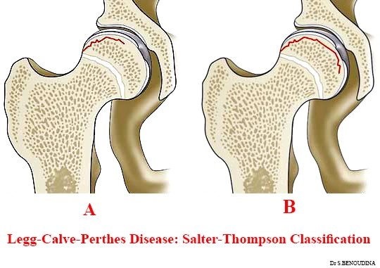 Hoại tử vô mạch vô căn chỏm xương đùi ở trẻ em (Perthes disease/Legg-Calvé-Perthes disease)