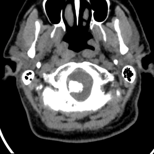 Khối giả U vôi hóa của trục thần kinh (Calcifying pseudoneoplasms of the neuraxis - CAPNON) 