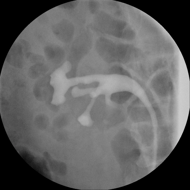 Giả túi thừa niệu quản (Ureteral pseudodiverticulosis)