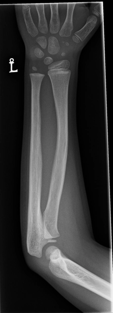 Gãy cong (Bowing fracture)