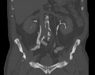 Niệu quản chẻ đôi (Bifid ureter)