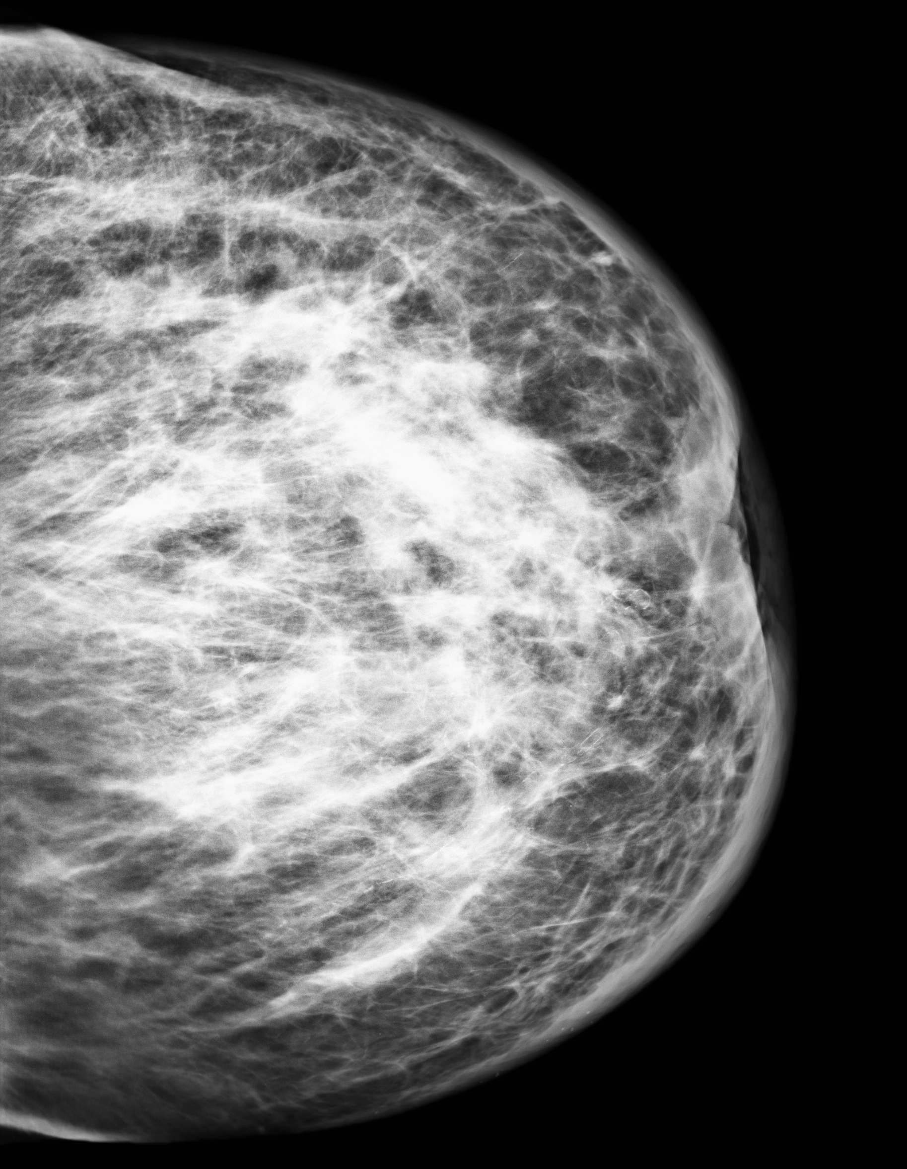 Ung thư biểu mô tuyến vú dạng viêm (Inflammatory carcinoma of the breast)