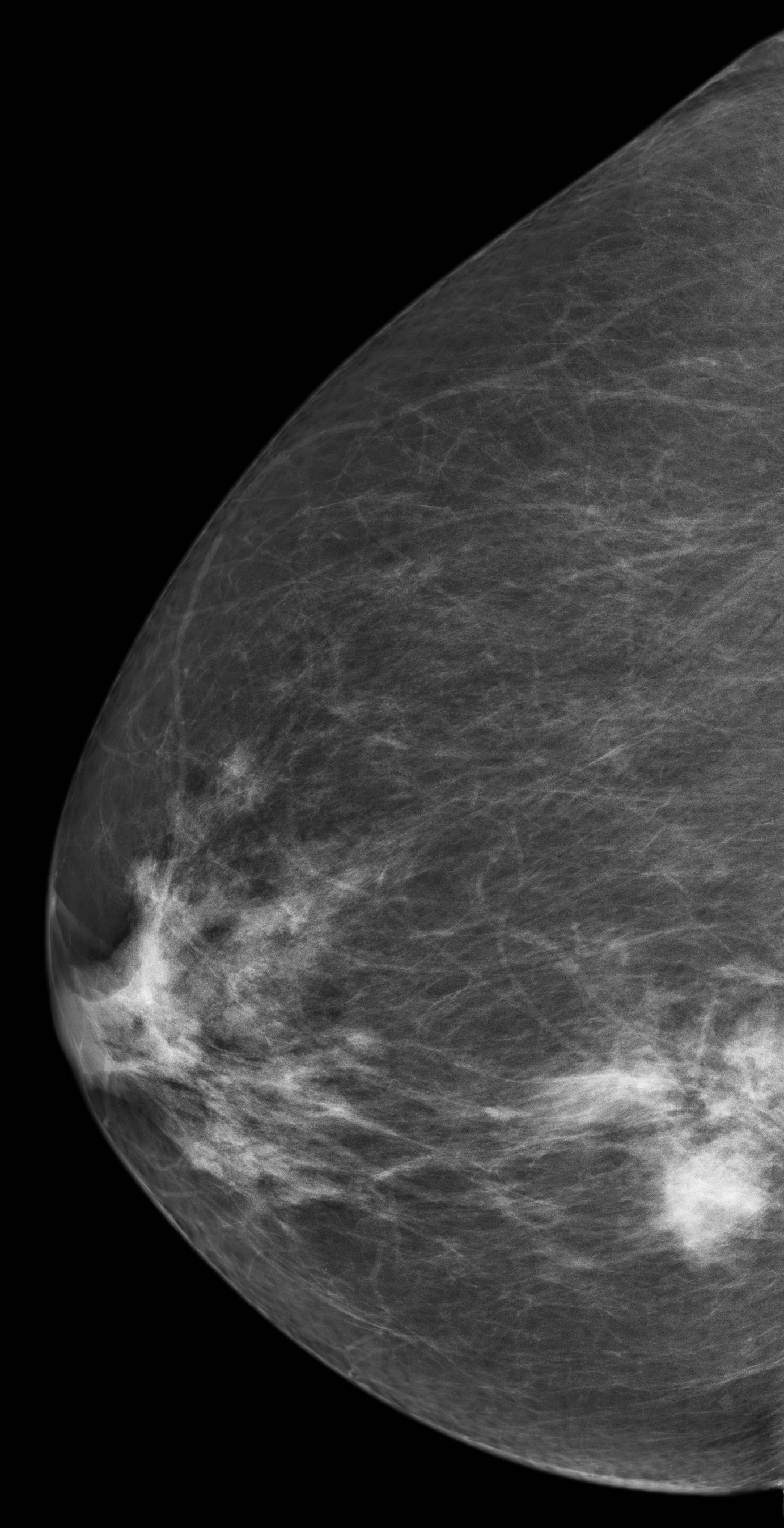 Ung thư biểu mô tiểu thùy vú (Lobular breast carcinoma)