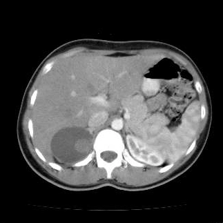 Nang tuyến thượng thận (Adrenal cyst)