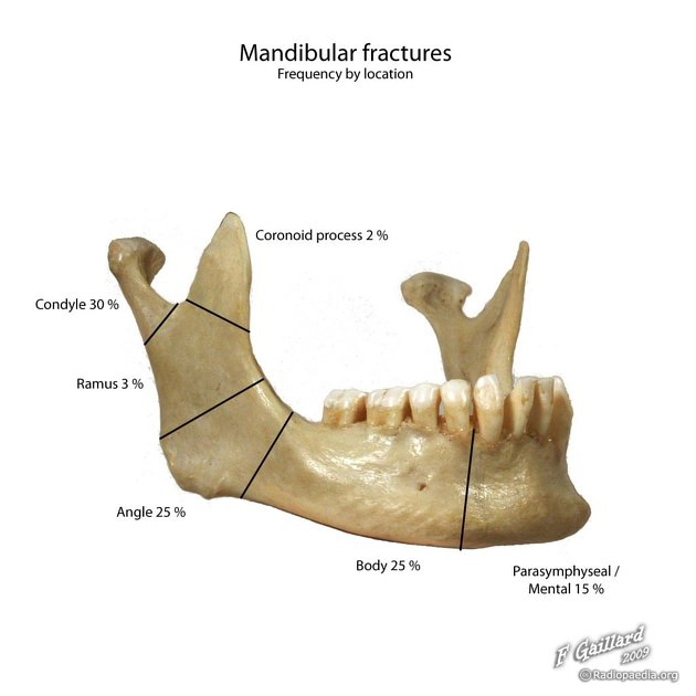 Gãy xương hàm dưới (Mandibular fracture)
