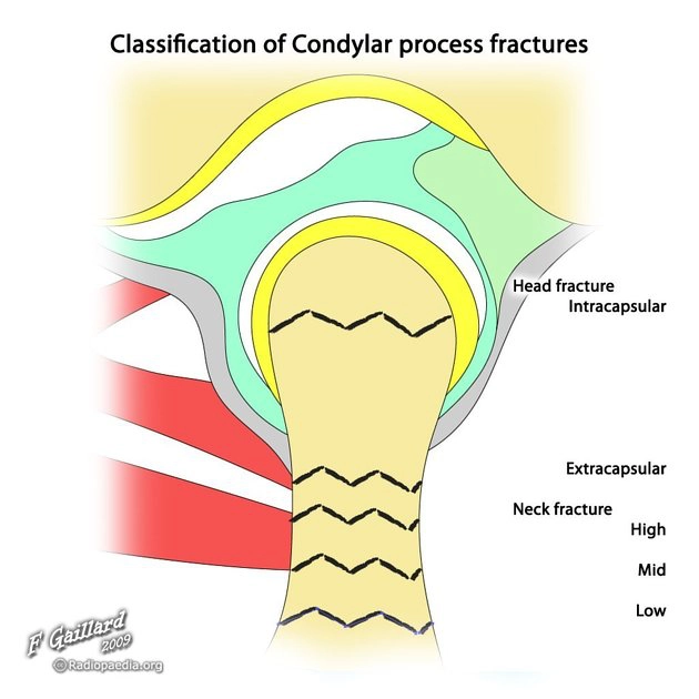 Gãy lồi cầu khớp thái dương hàm (Condylar process fractures)