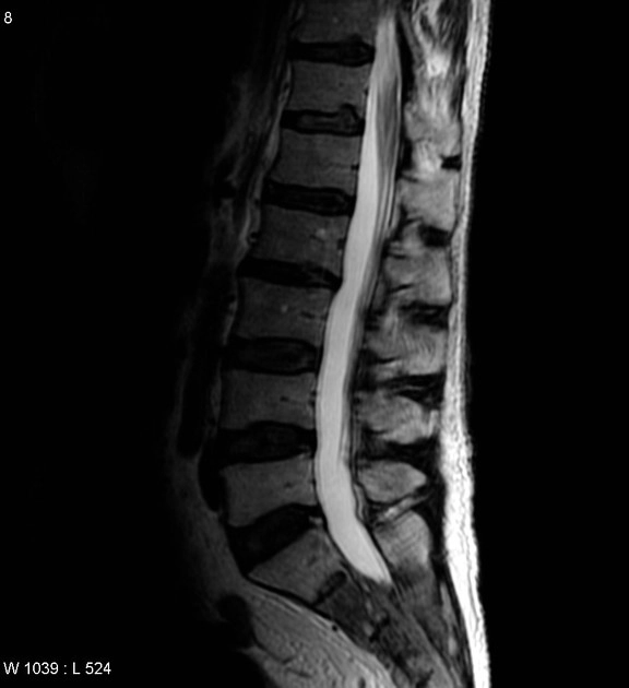 Ung thư biểu mô tuyến tiền liệt (Prostate cancer)