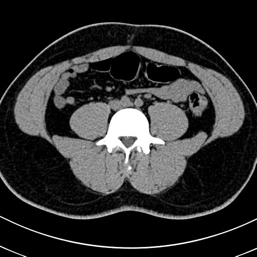 Áp xe ruột thừa (Appendicular abscess)