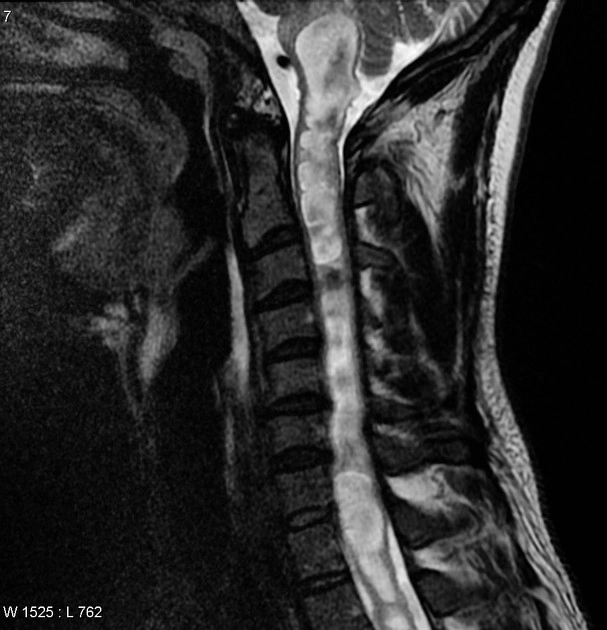 U nguyên bào mạch máu cột sống (Spinal hemangioblastoma)