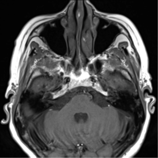 U màng não thần kinh thị (Optic nerve sheath meningioma)
