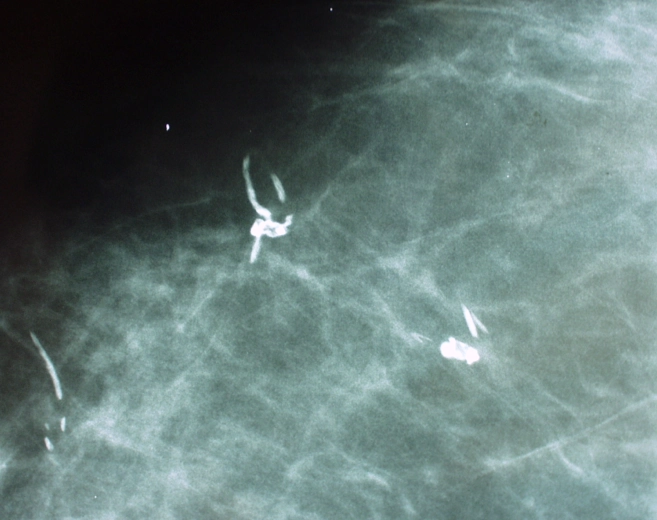 Vôi hóa chỉ khâu (Suture calcification in breast)