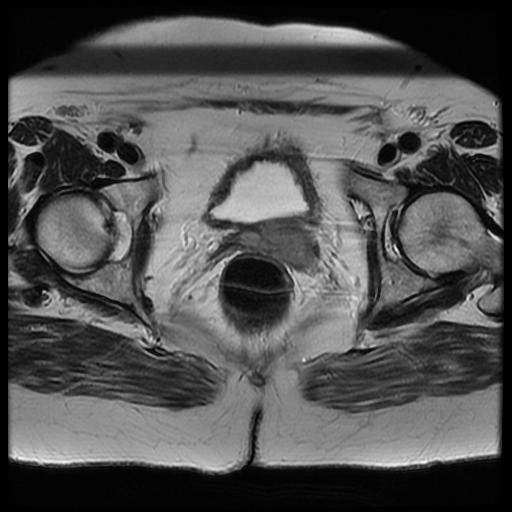 Carcinoma âm đạo (Primary vaginal carcinoma)