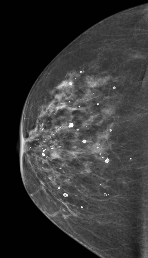 Vôi hóa dạng tròn (Round breast calcifications)