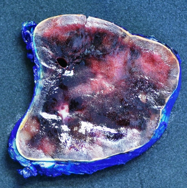 U tủy mỡ thượng thận (Adrenal myelolipoma)