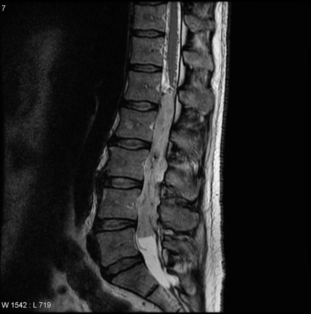 U thần kinh nội tiết vùng đuôi ngựa (Cauda equina neuroendocrine tumor)