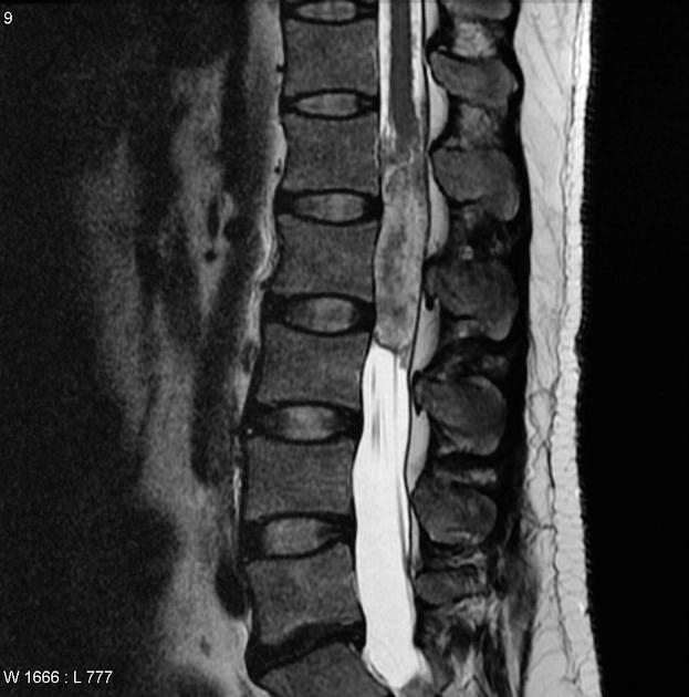 U màng nội tủy thể nhầy nhú (Myxopapillary ependymoma)