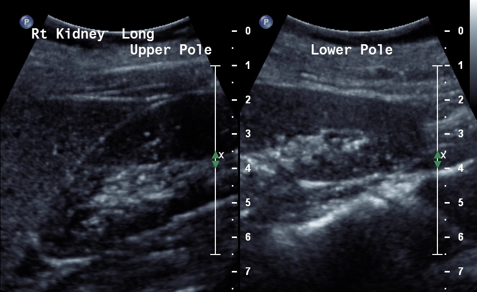 Bệnh thận do Lithium (Lithium-induced renal disease)
