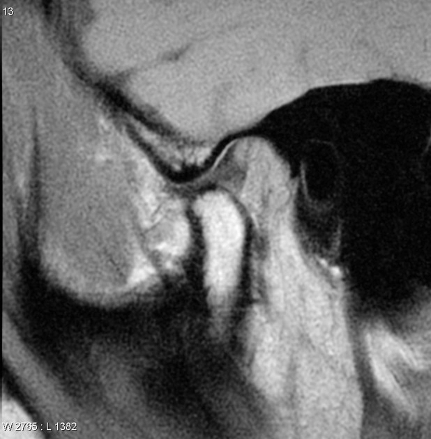 Tràn dịch khớp thái dương hàm (Temporomandibular joint effusion)