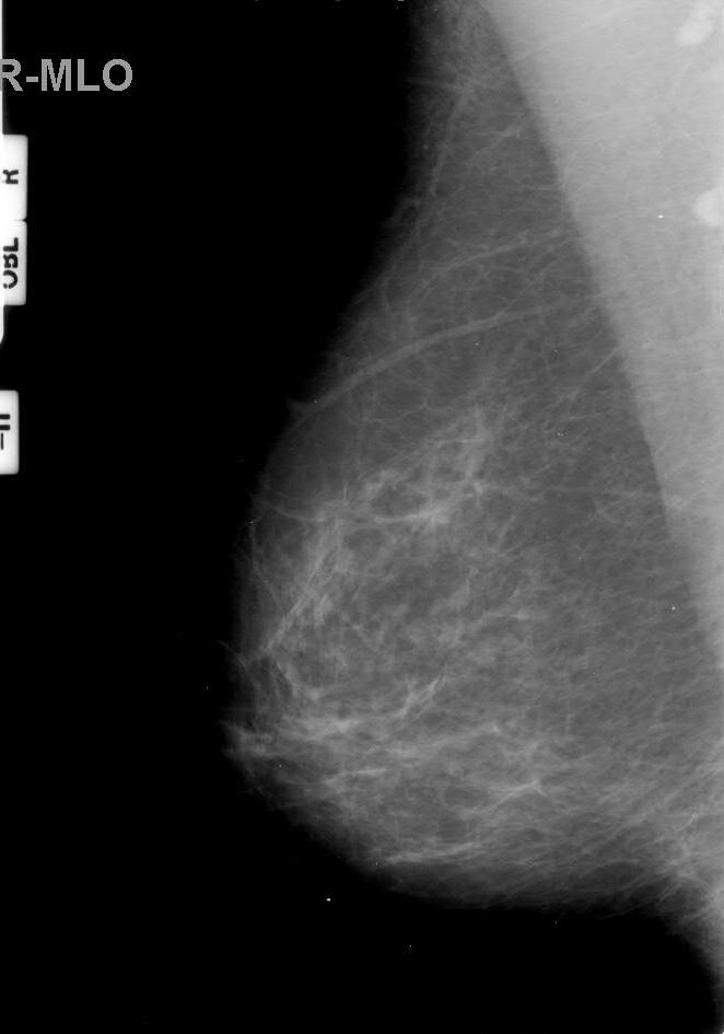 U tế bào hạt tuyến vú (Granular cell tumor of the breast)