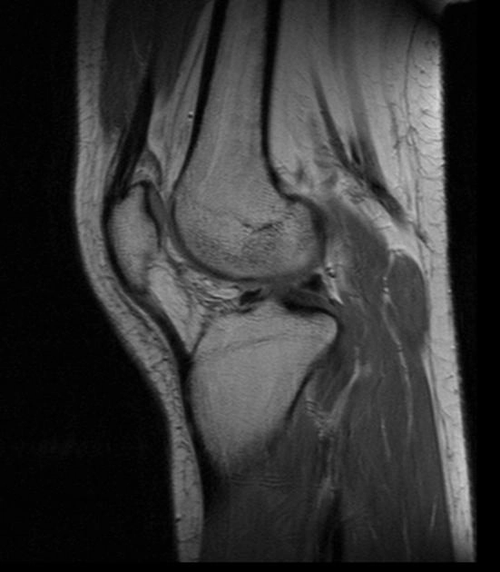 Xương bánh chè nằm thấp (Patella baja)