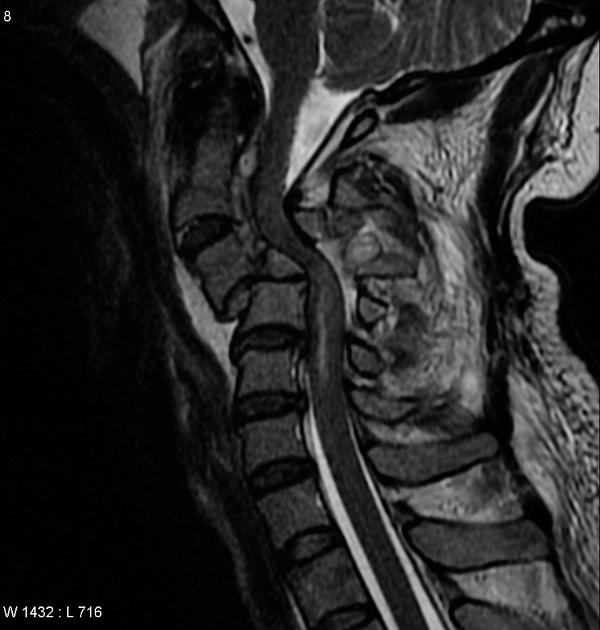 Gãy trật do gập mạnh (Gãy Chance )