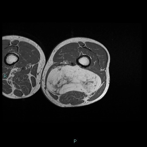 U mỡ không điển hình / Liposarcoma biệt hóa tốt (Atypical Lipomatous Tumor / Well-Differentiated Liposarcoma - ALT/WDLPS) 