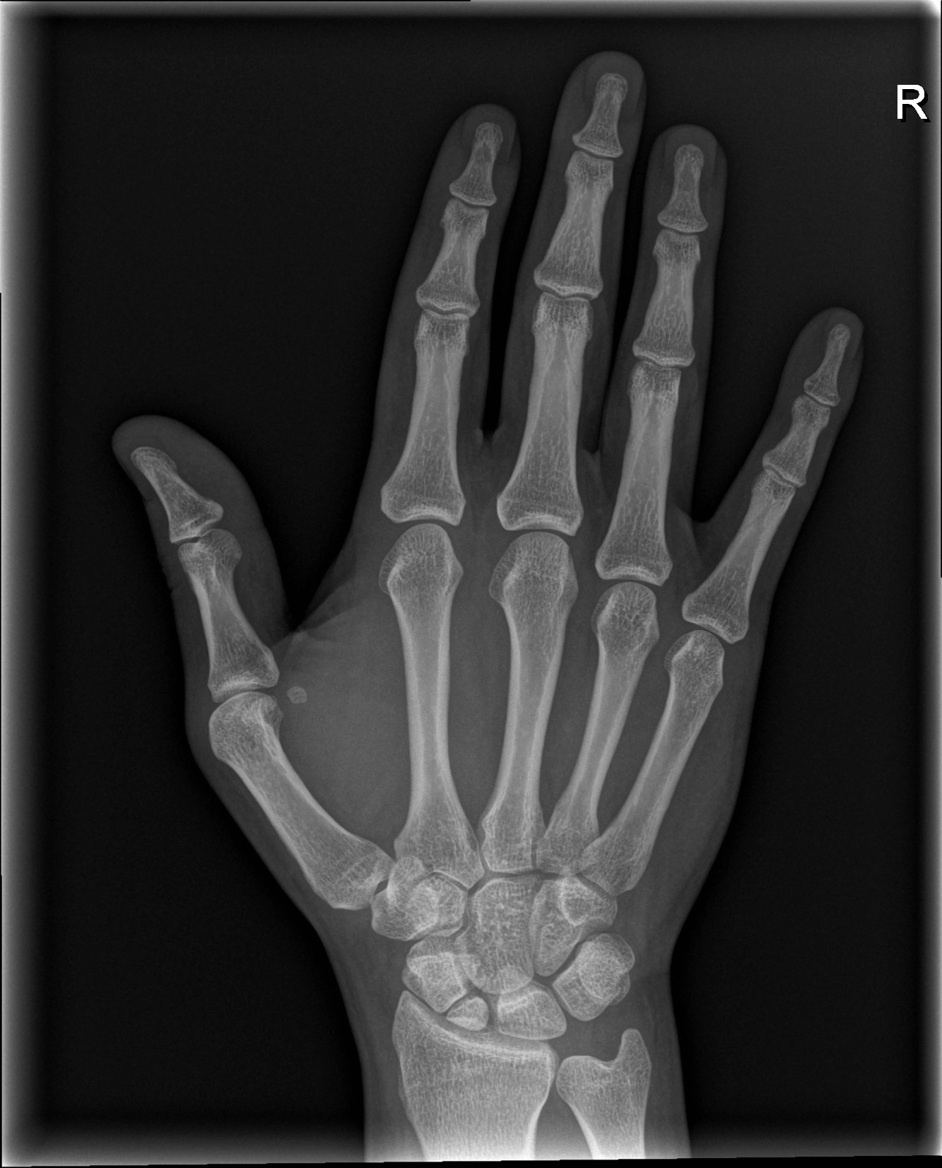 Xương thuyền đôi (Bipartite scaphoid)