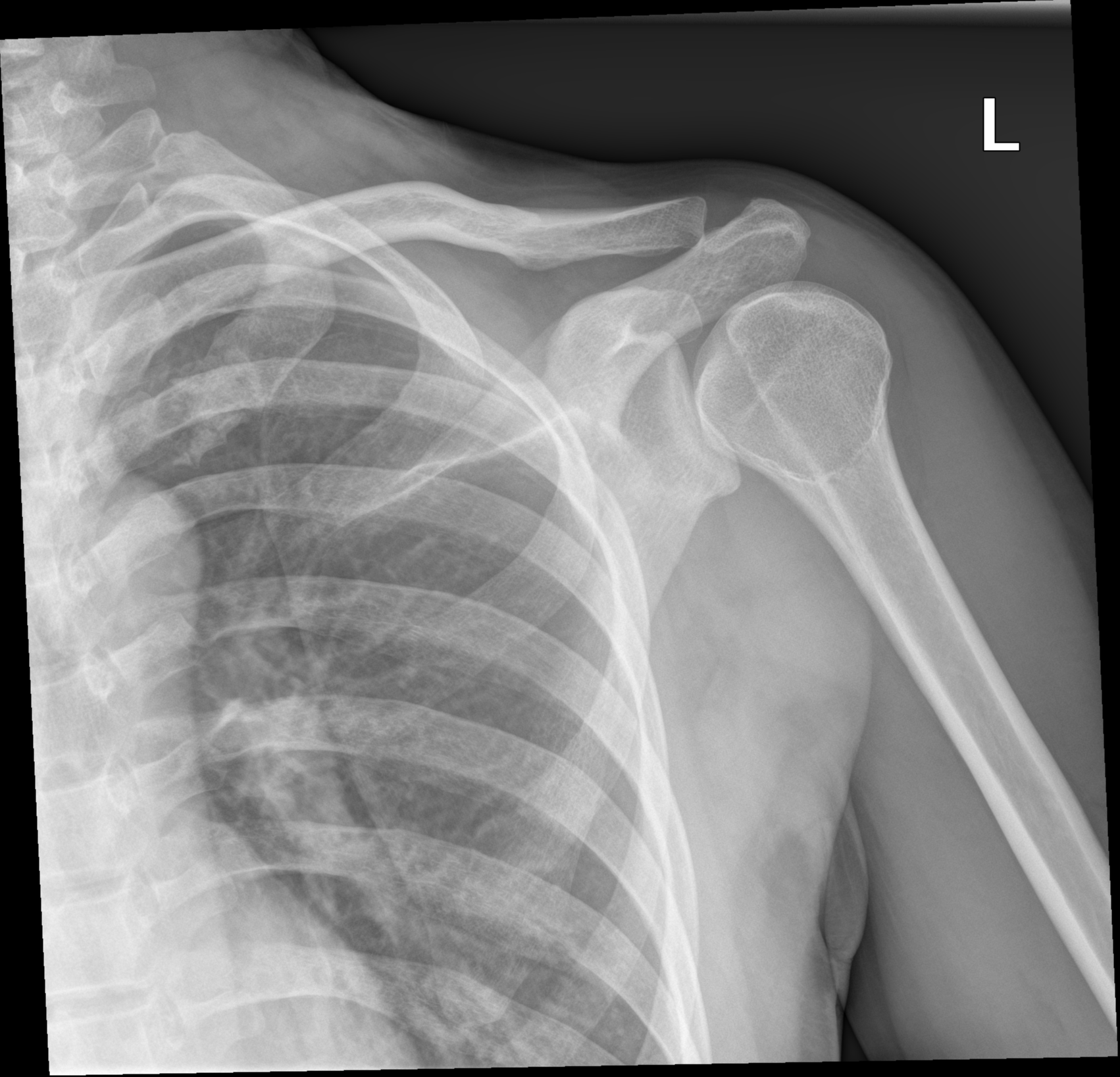Giả nang xương Cánh Tay (Pseudocyst Of The Humerus)