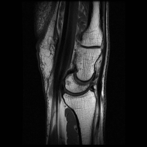 Góc Cả-Nguyệt (Capitolunate angle)