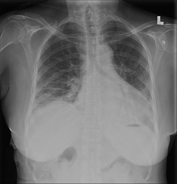 Viêm phổi kẽ cấp tính (Acute Interstitial Pneumonia - AIP)