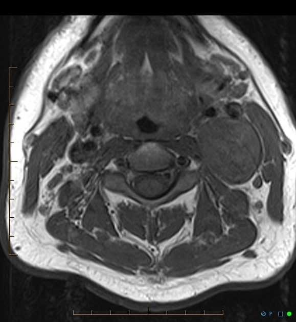Schwannoma dây thần kinh lang thang (Vagal schwannoma)