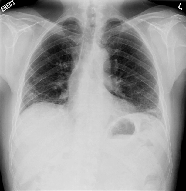 Viêm đa cơ (biểu hiện ở phổi) - Polymyositis (pulmonary manifestations)