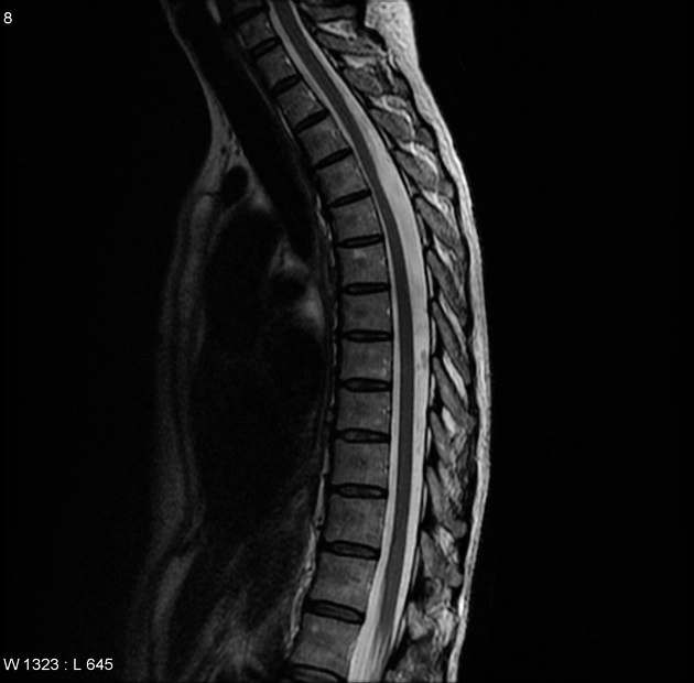 Nang màng nhện cột sống (Spinal arachnoid cyst)