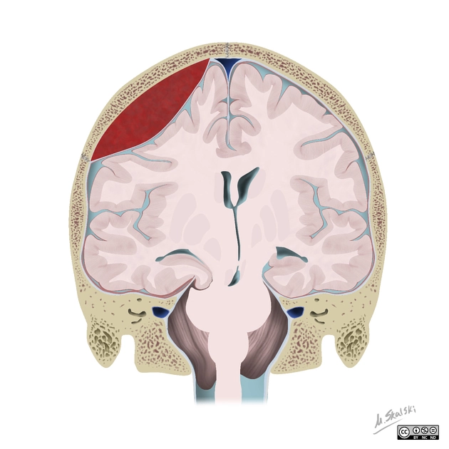 Thoát vị não (Brain herniation)
