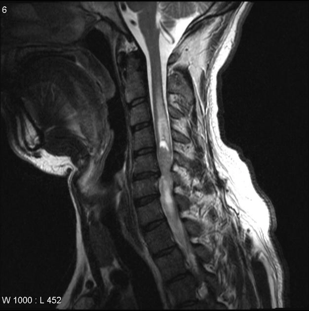 U màng nội tủy cột sống (Spinal ependymoma)