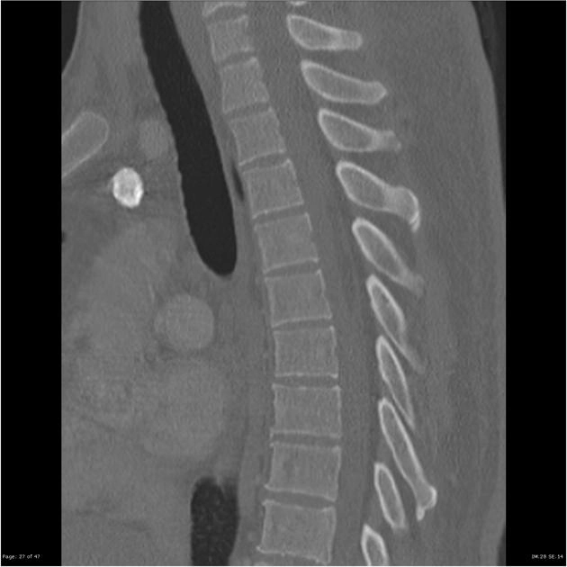 U mỡ trong màng cứng (Intradural lipoma)