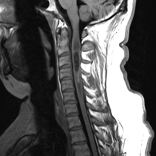 U nội tủy sống (Intramedullary spinal tumors)