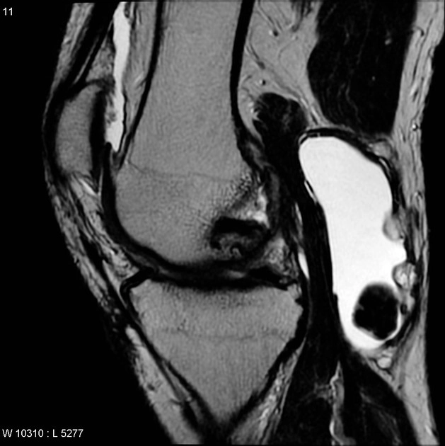 U sụn màng hoạt dịch nguyên phát (Primary synovial chondromatosis)