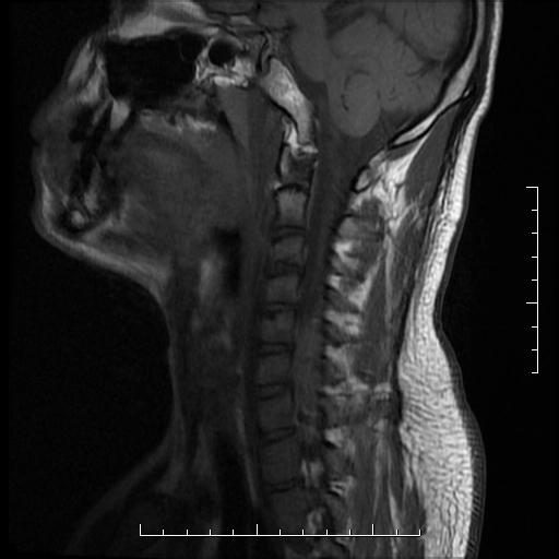 Tụ máu ngoài màng cứng cột sống (Spinal epidural hematoma)
