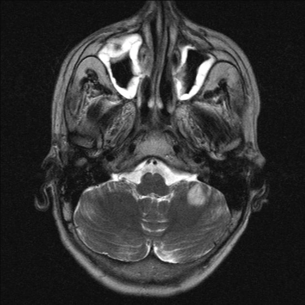 Viêm xoang do nấm xâm lấn cấp tính (Acute invasive fungal sinusitis - AIFS)
