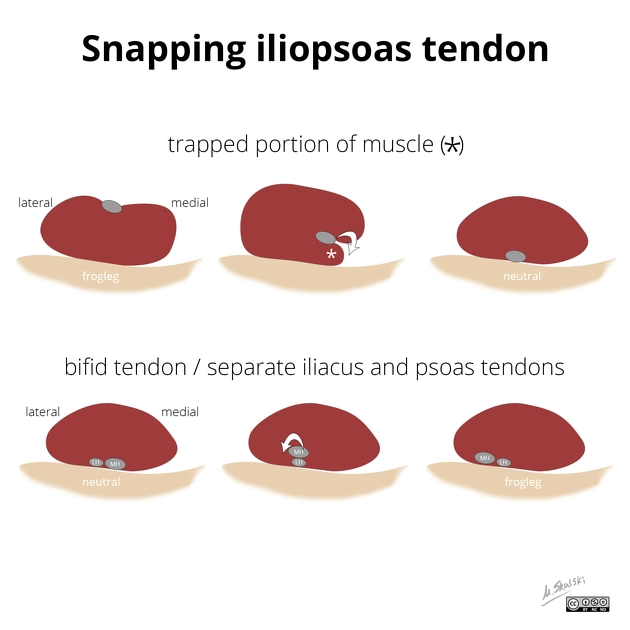 Háng kêu do gân cơ thắt lưng chậu (Snapping iliopsoas tendon)