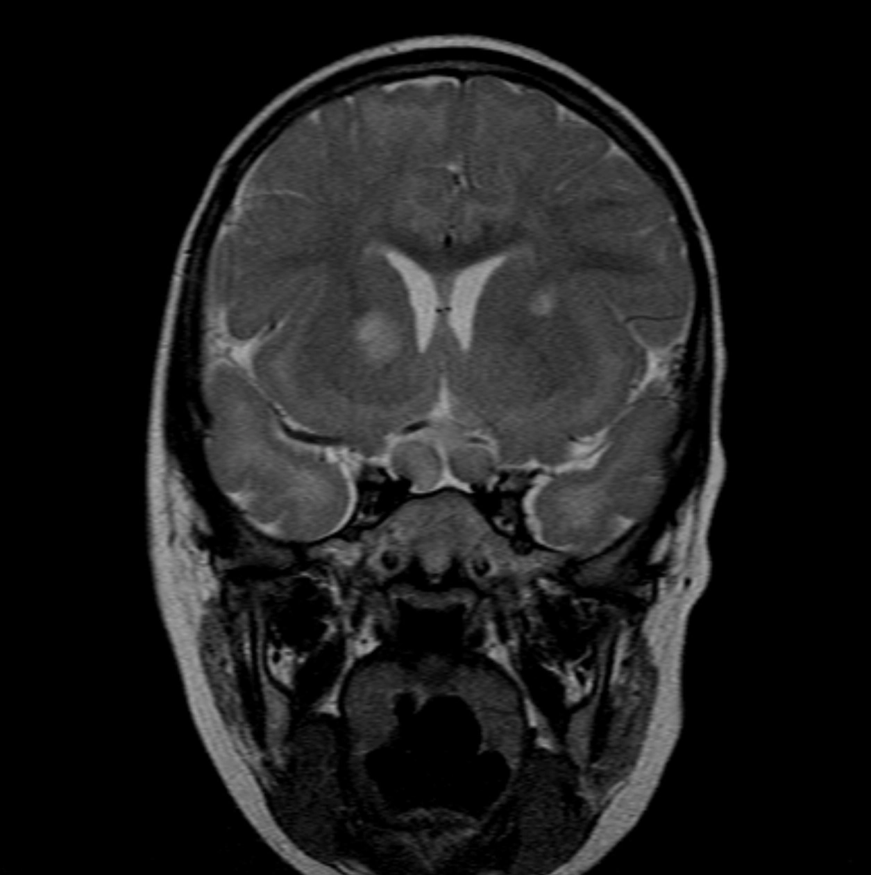 U tế bào đệm đường thị giác (Optic pathway gliomas - OPGs)