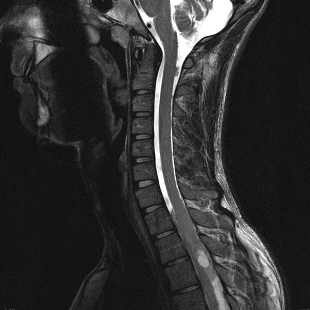 U sao bào tủy sống (Spinal astrocytoma)