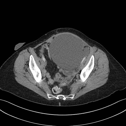 Nang niệu (Urinoma)