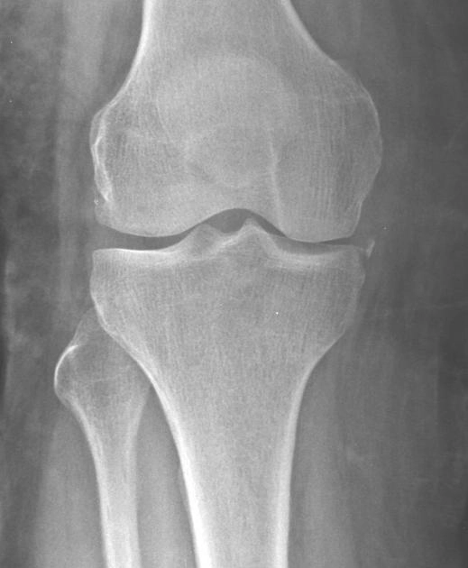 Gãy Segond ngược/Gãy bong mâm chày trong