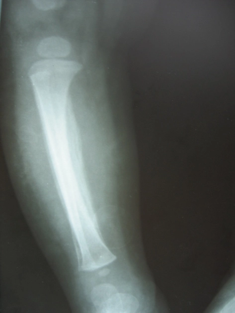 Bệnh tăng vỏ xương ở trẻ sơ sinh (Infantile cortical hyperostosis)/ Bệnh Caffery 