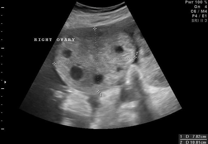 Hội chứng quá kích buồng trứng (Ovarian Hyperstimulation Syndrome - OHSS)